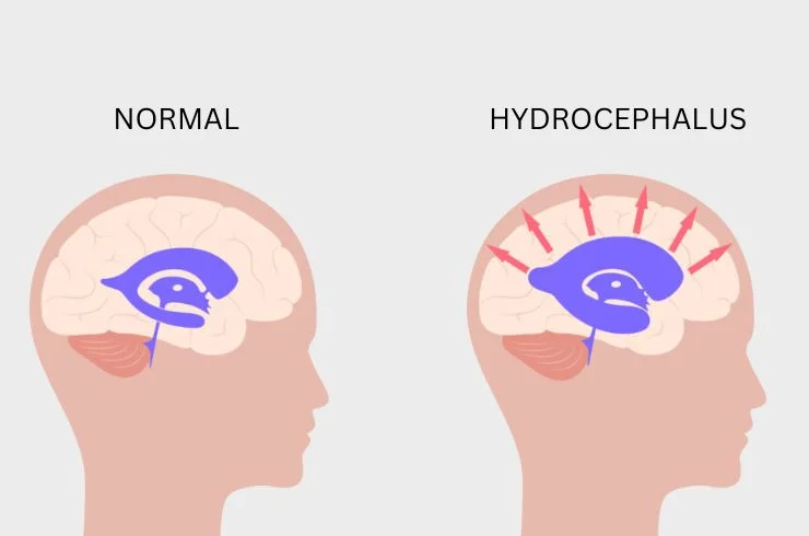 Hydrocephalus